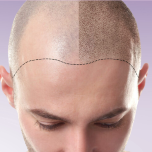 Mal with Scalp Micropigmentation